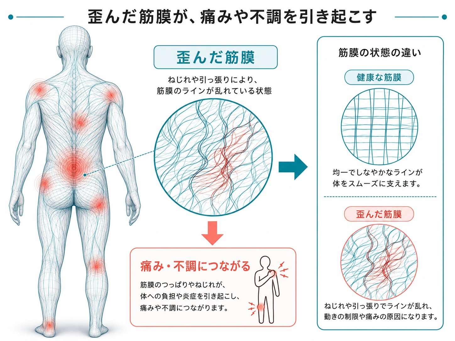 全身を覆う筋膜の線と、筋膜の状態の違いを網目で示した概念図